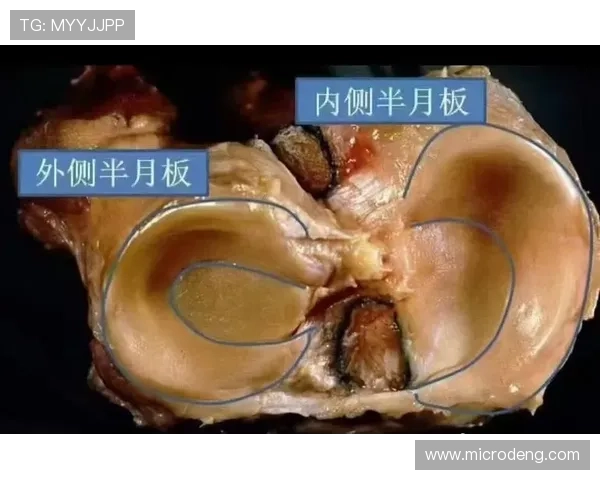 加维半月板损伤恢复进展与当前状态分析